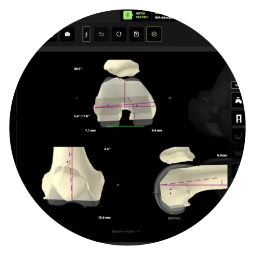 Planificateur 3D Genou