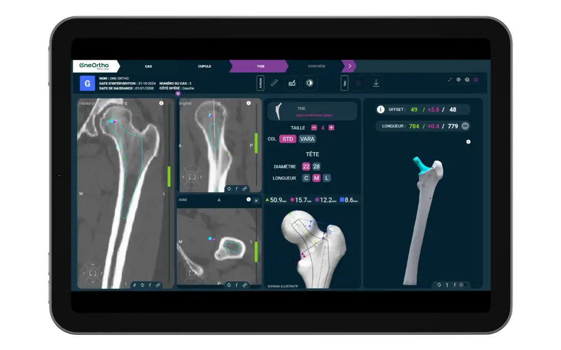 Vue scanner fémorale