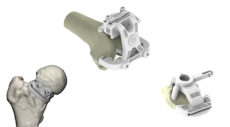 Instrumentation patient-spécifique : guides de coupe imprimés en 3D sur le fémur