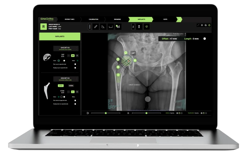Calques 2D de la hanche OneOrtho sur ordinateur portable