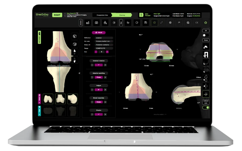 Logiciel de planification 3D du genou OneOrtho sur ordinateur portable