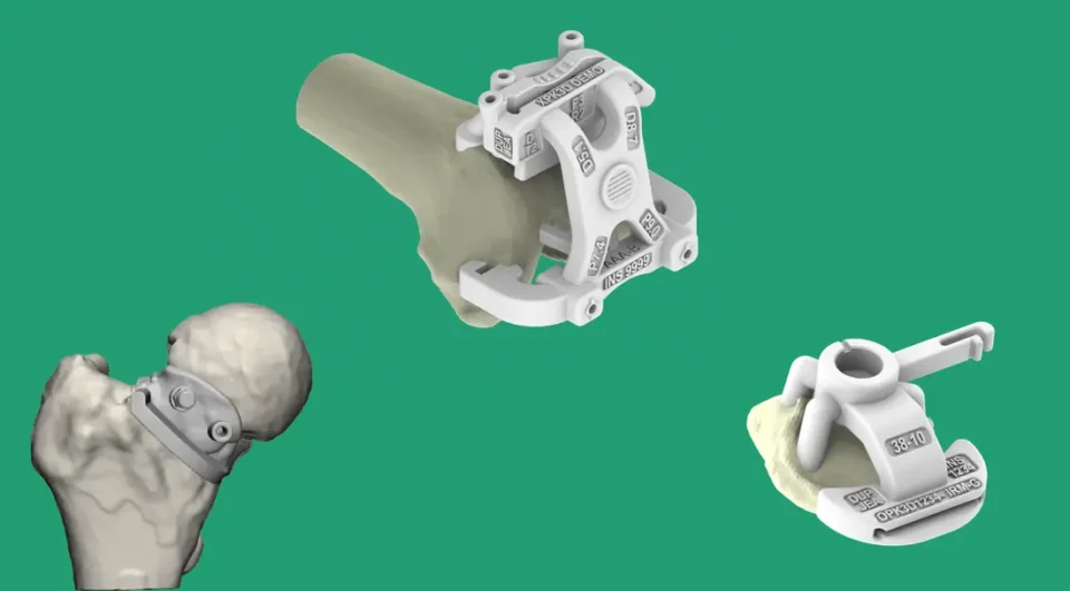 Guides de coupe patient-spécifiques imprimés en 3D sur le fémur