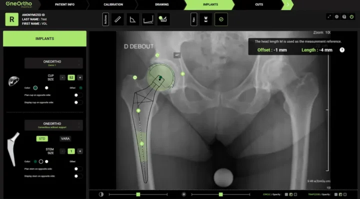 Logiciel de planification 2D de la hanche : calques numériques des implants sur la radiographie