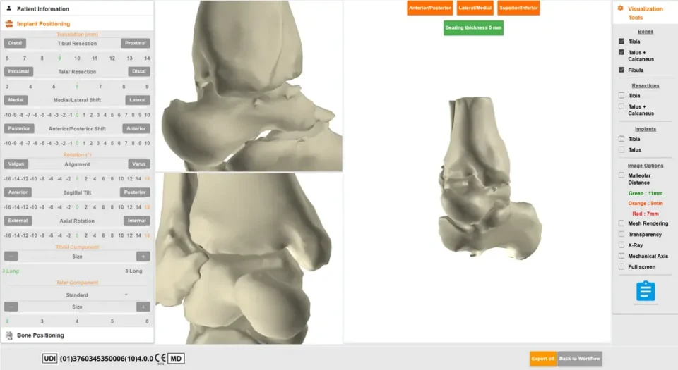 Planification 3D de la cheville : reconstruction 3D du tibia et du talus