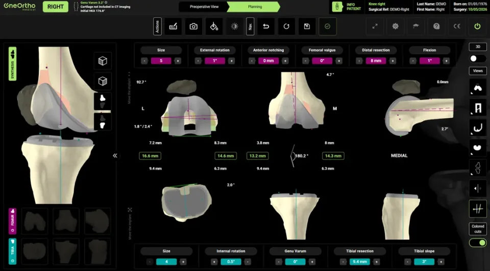 Logiciel de planification 3D du genou : positionnement des implants et des coupes osseuses