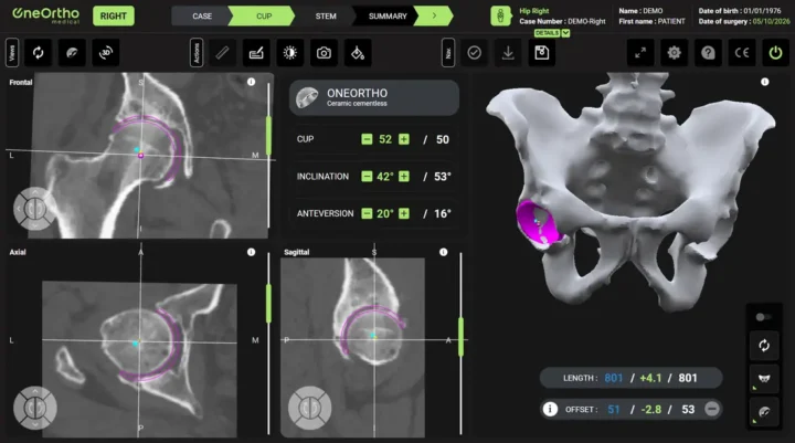 Logiciel de planification 3D de la hanche : positionnement de l'implant sur la reconstruction du scanner