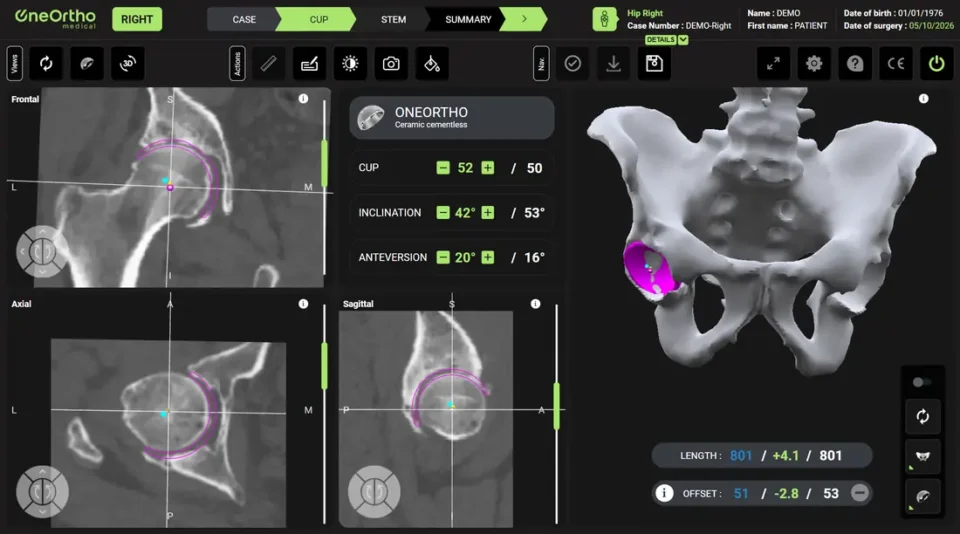 Logiciel de planification 3D de la hanche : positionnement de l'implant sur la reconstruction du scanner